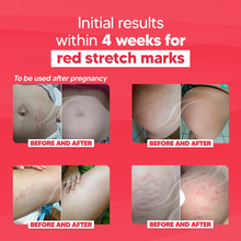 Load image into Gallery viewer, CicatrissimRed - RED Stretch Marks Cream Only - 3 months treatment

